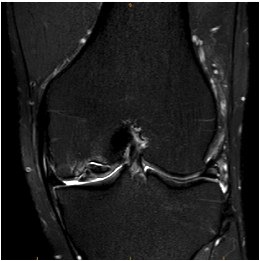 Knee OCD Type 3